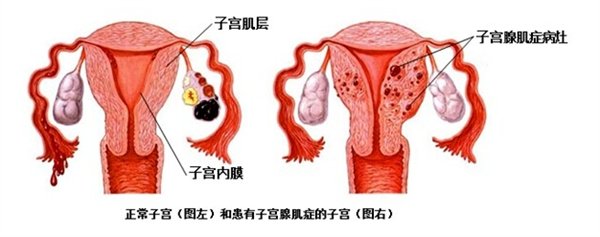腺肌症备孕需要注意哪些事项?护航健康孕育之旅