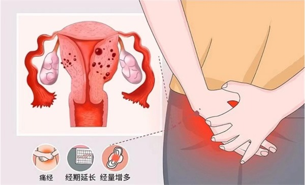 隐匿的疼痛，悄然生长的秘密：腺肌症的早期信号与警醒