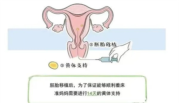腺肌症患者如何提高胚胎移植成功率?
