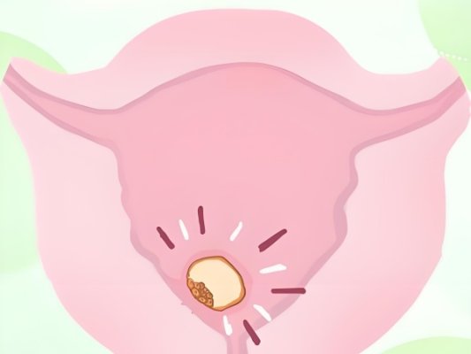 试管婴儿：移植后有出血是怎么回事