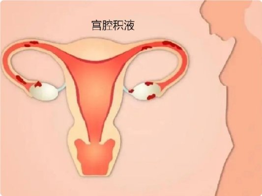宫腔积液对格鲁吉亚和吉尔吉斯斯坦试管胚胎移植有哪些影响?