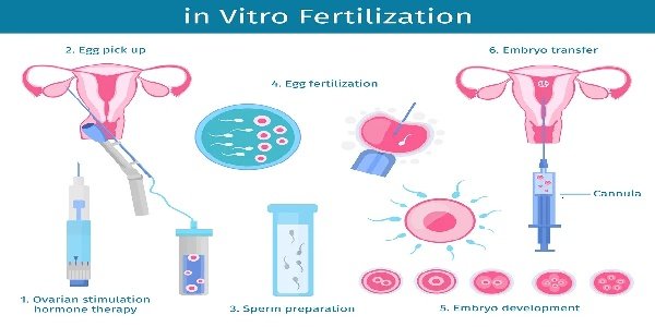 试管婴儿技术如何选择?科学助孕需"对症下药"