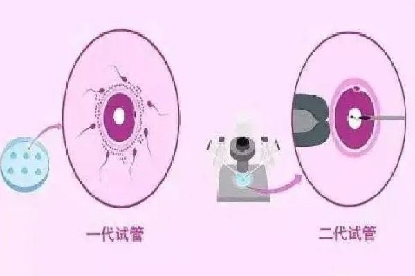第一代试管婴儿技术主要是解决哪些问题