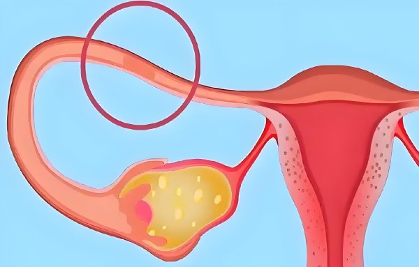 移植前发现输卵管积水，还能继续么?