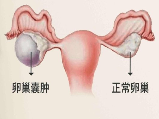 卵巢囊肿对吉尔吉斯斯坦试管成功率有哪些影响? 爱宝来为您解答