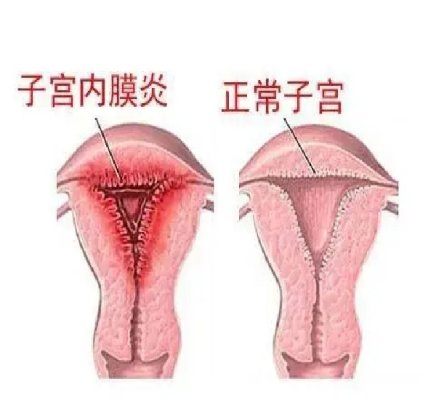 内膜炎对吉尔吉斯斯坦试管婴儿成功率有哪些影响?