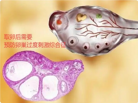 吉尔吉斯斯坦试管婴儿助孕：取卵后如何预防腹水
